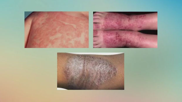 충주피부과 환절기에 붉어지고 부어오른 증상은? 충주피부과 환절기에 붉어지고 부어오른 증상은?